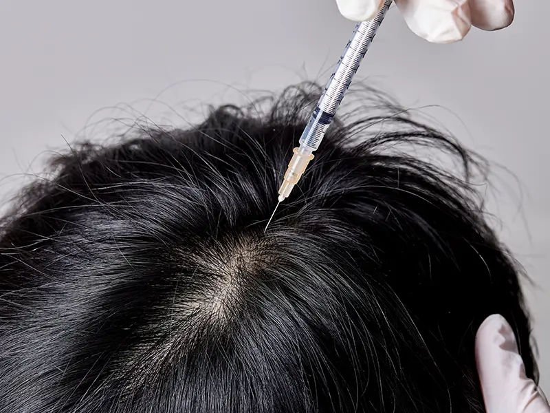 PRP Injection Technique - TIME Anti-Aging and Hair Transplant Center